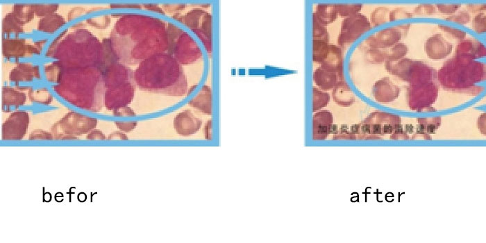 Inflammatory cells before and after laser treatment