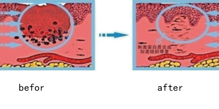 Tissue repaired after laser treatment