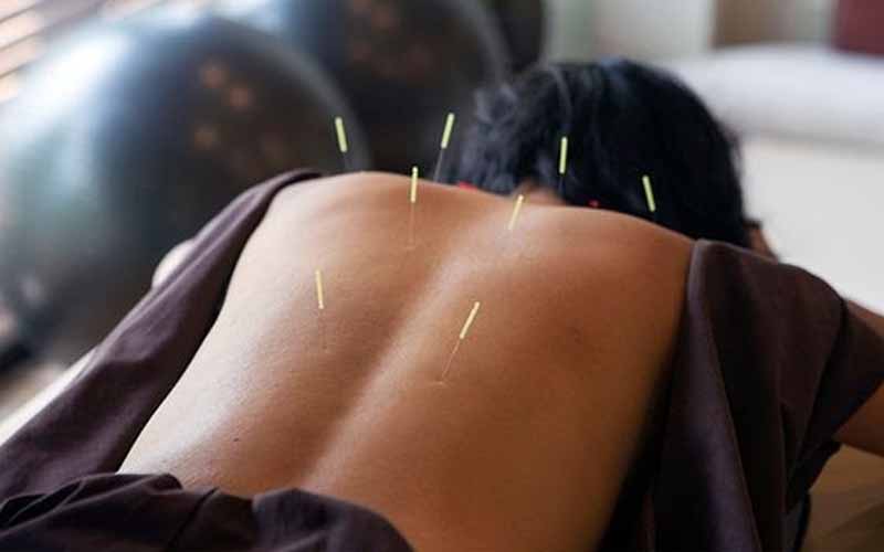 Acupuncture-Needle-on-the-Back