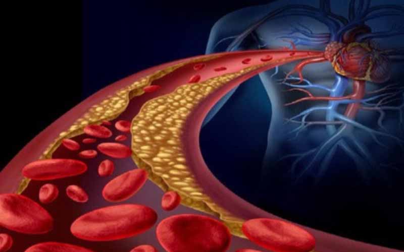 Arteriosclerosis