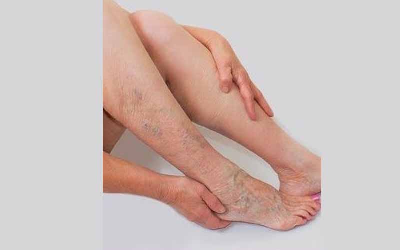 Varicose Veins