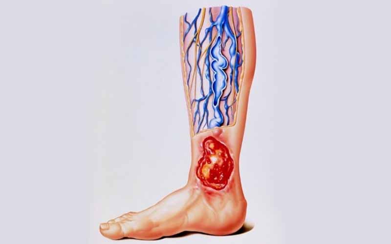 Venous Ulcers Illustration