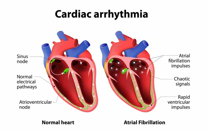 Arrhythmias