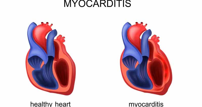 Heart Muscle Inflammation