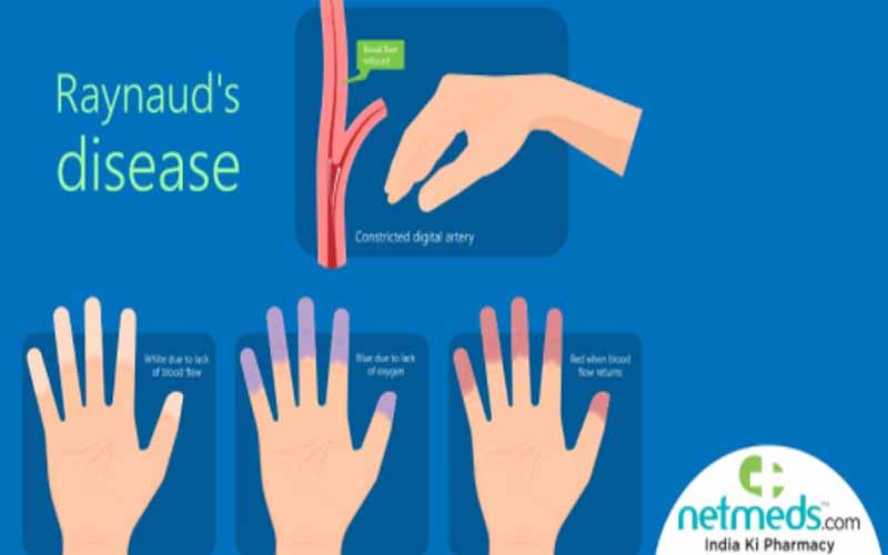 Raynaud’s Disease